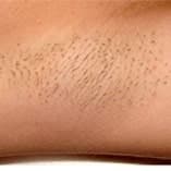 Vorher-Bild Laser-Haarentfernung Fall 3